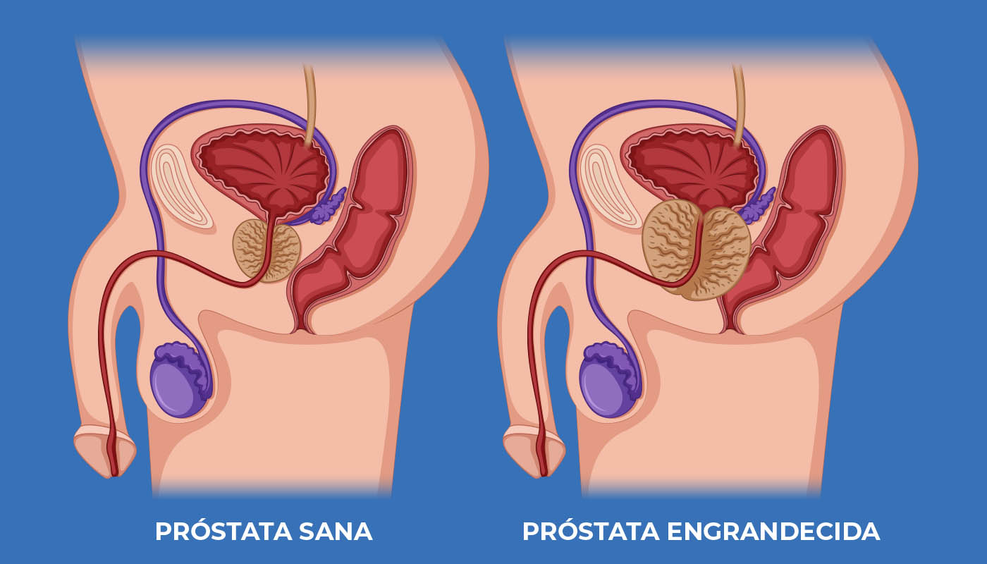 Disfunción Eréctil