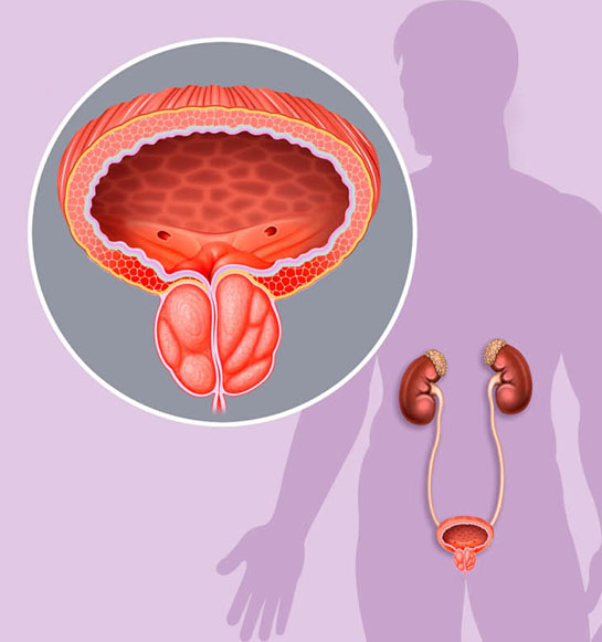 Disfunción Eréctil